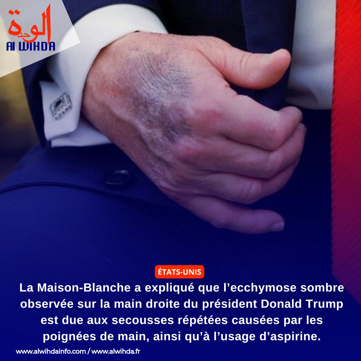 Les ecchymoses de Donald Trump : une énigme persistante